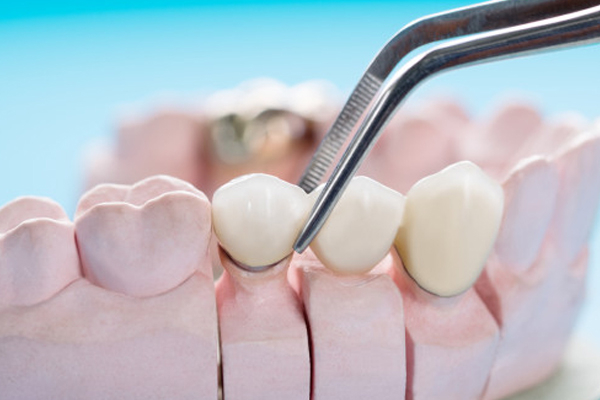 dental-bridge