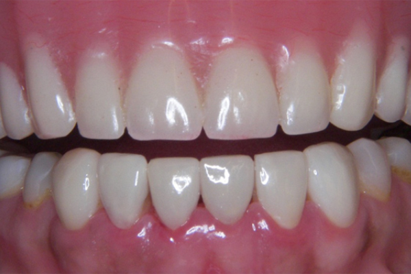 veneers